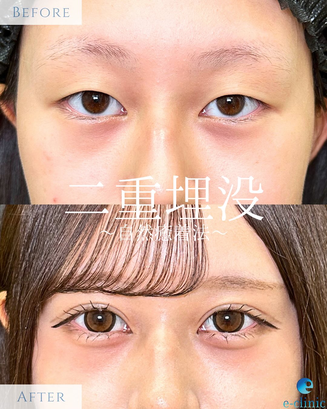 埋没法の症例写真 (4)
