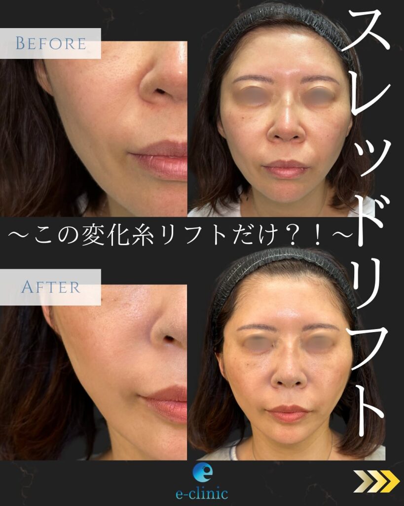 糸リフトの症例写真 (16)