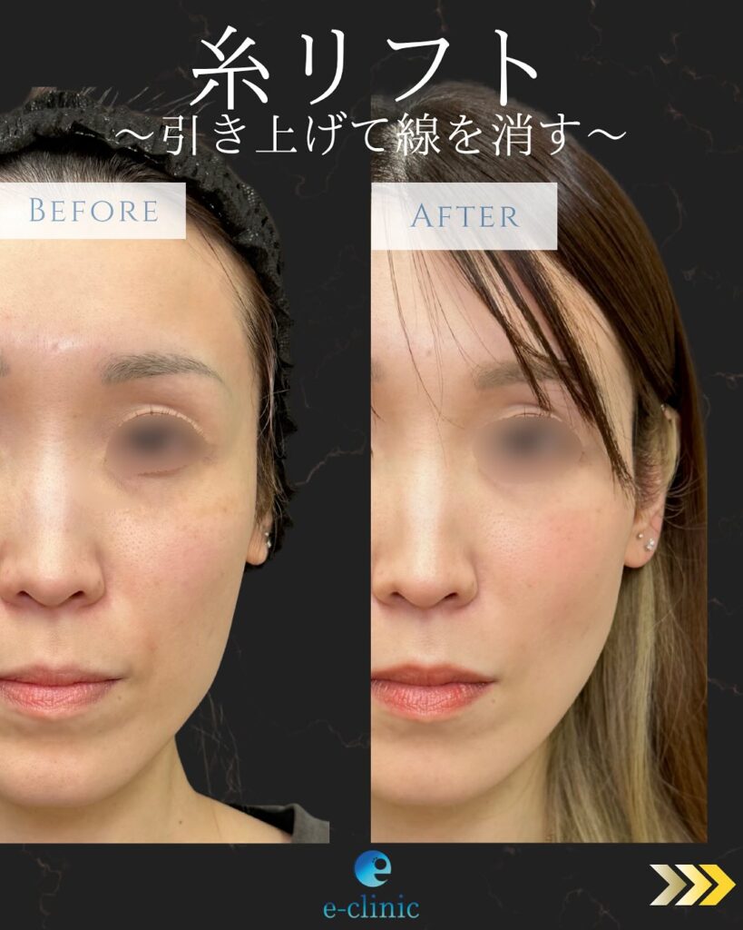 糸リフトの症例写真 (11)