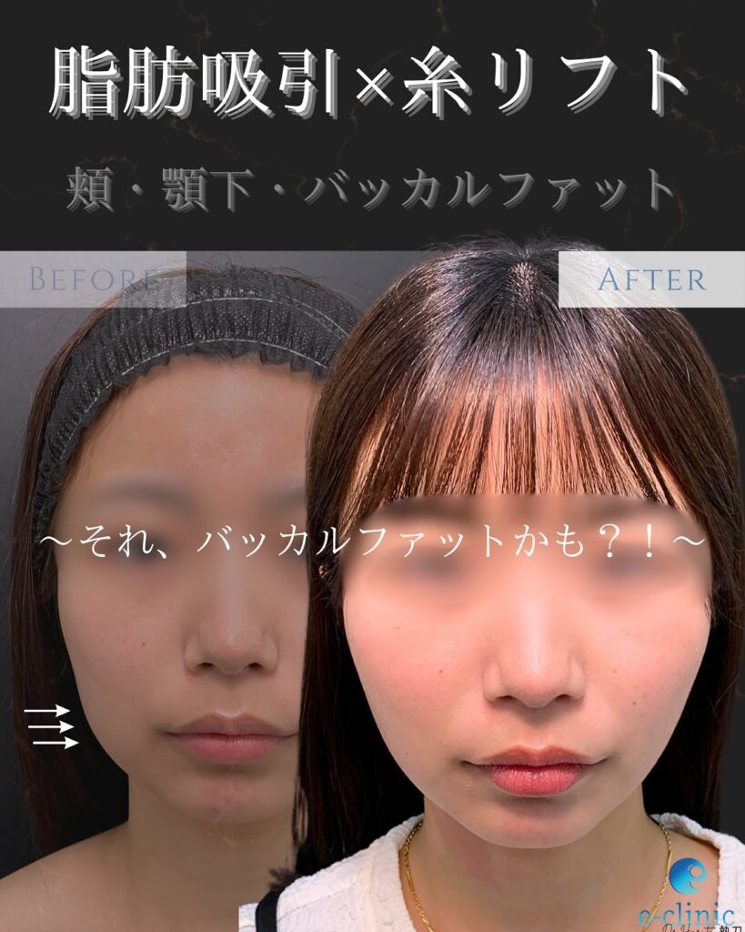 顔の脂肪吸引と糸リフトの症例写真 (4)