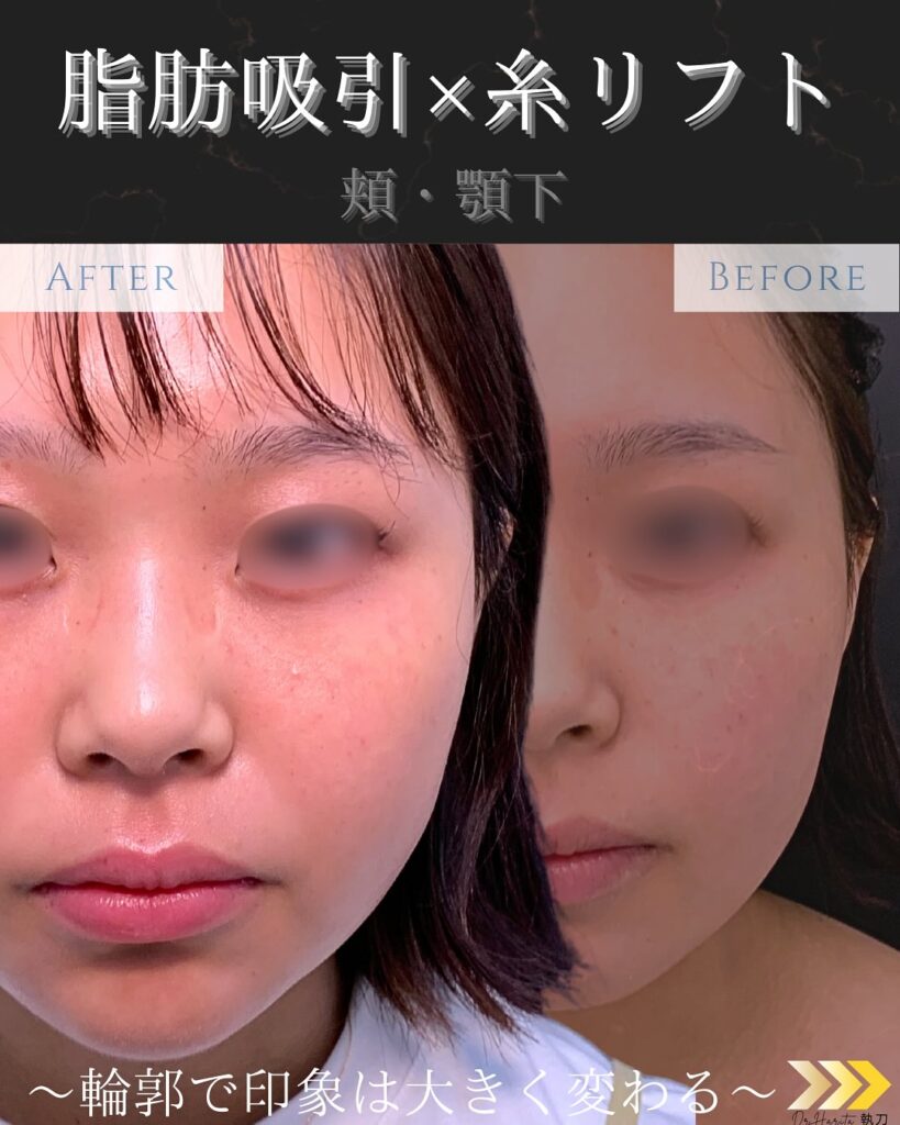 顔の脂肪吸引と糸リフトの症例写真 (1)