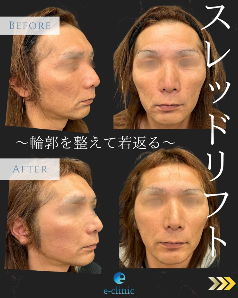 糸リフトの症例写真 (15)