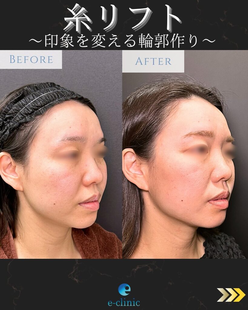 糸リフトの症例写真 (23)