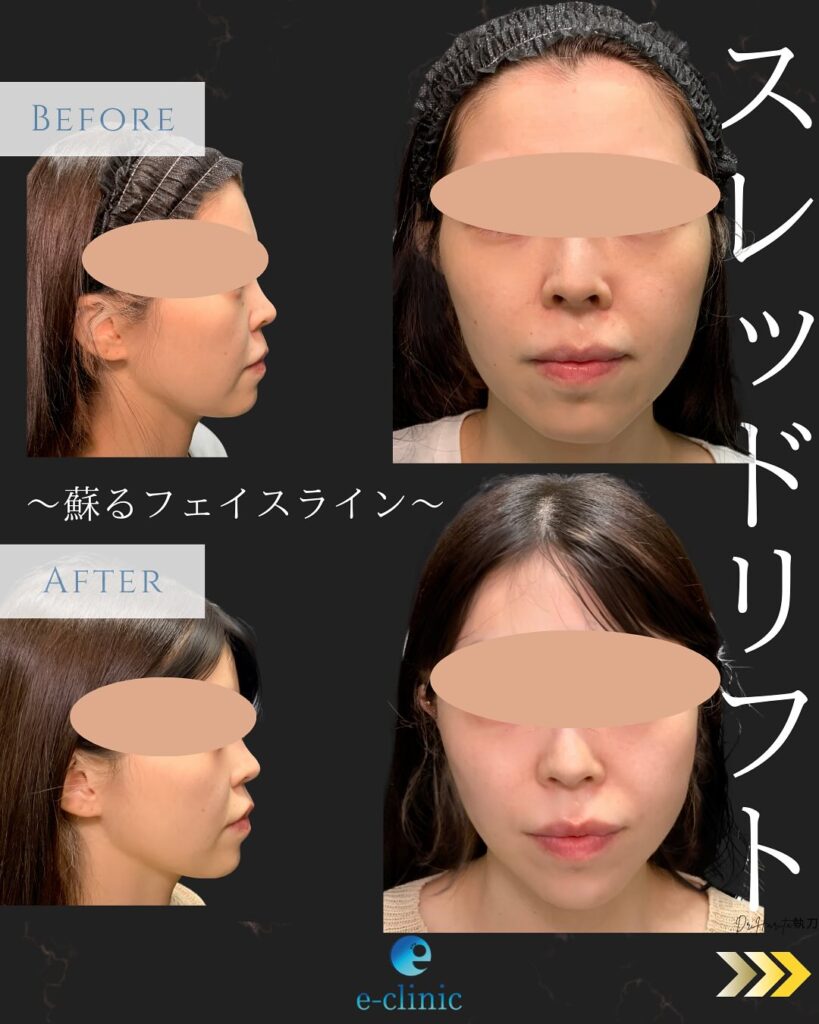 糸リフトの症例写真 (13)