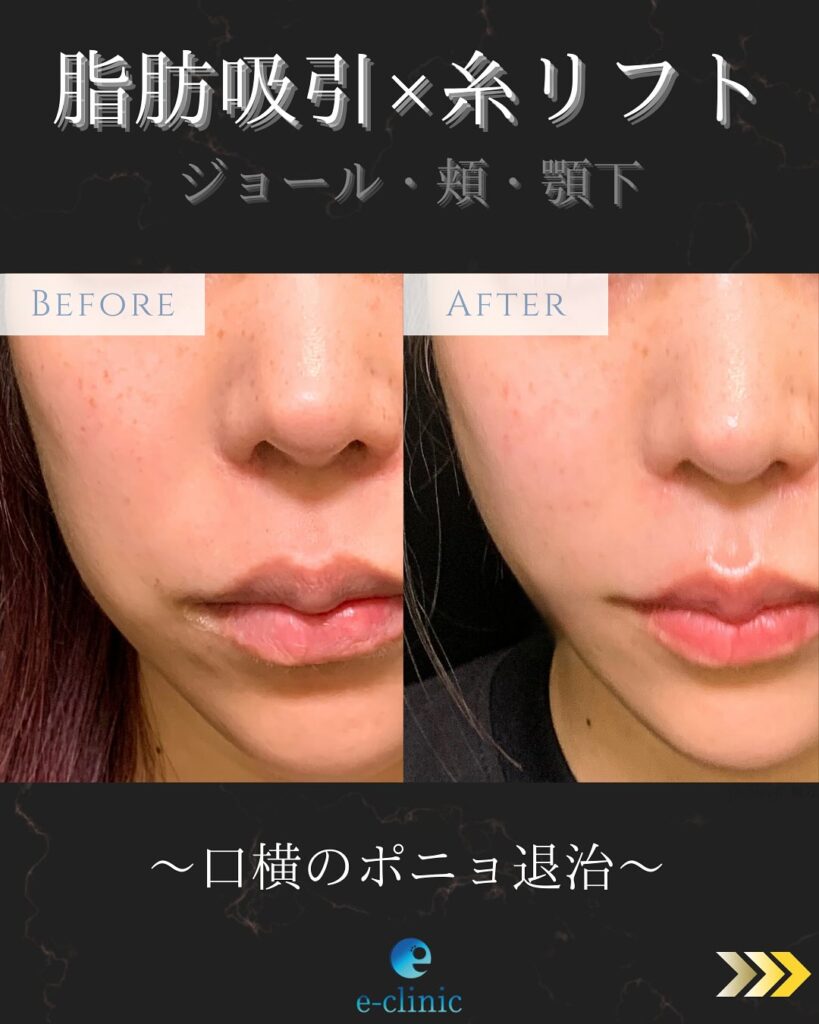 顔の脂肪吸引と糸リフトの症例写真 (3)