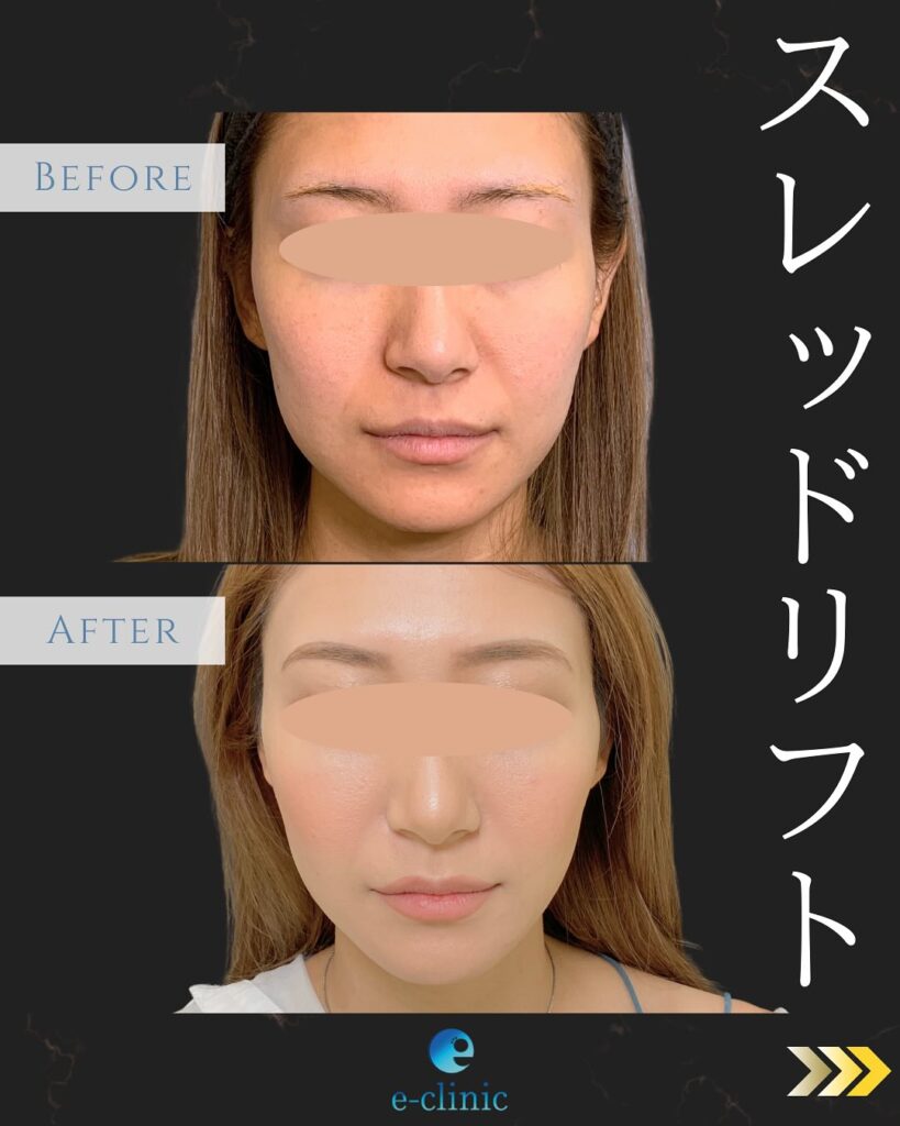 糸リフトの症例写真 (12)