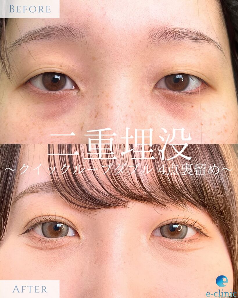埋没法の症例写真 (2)