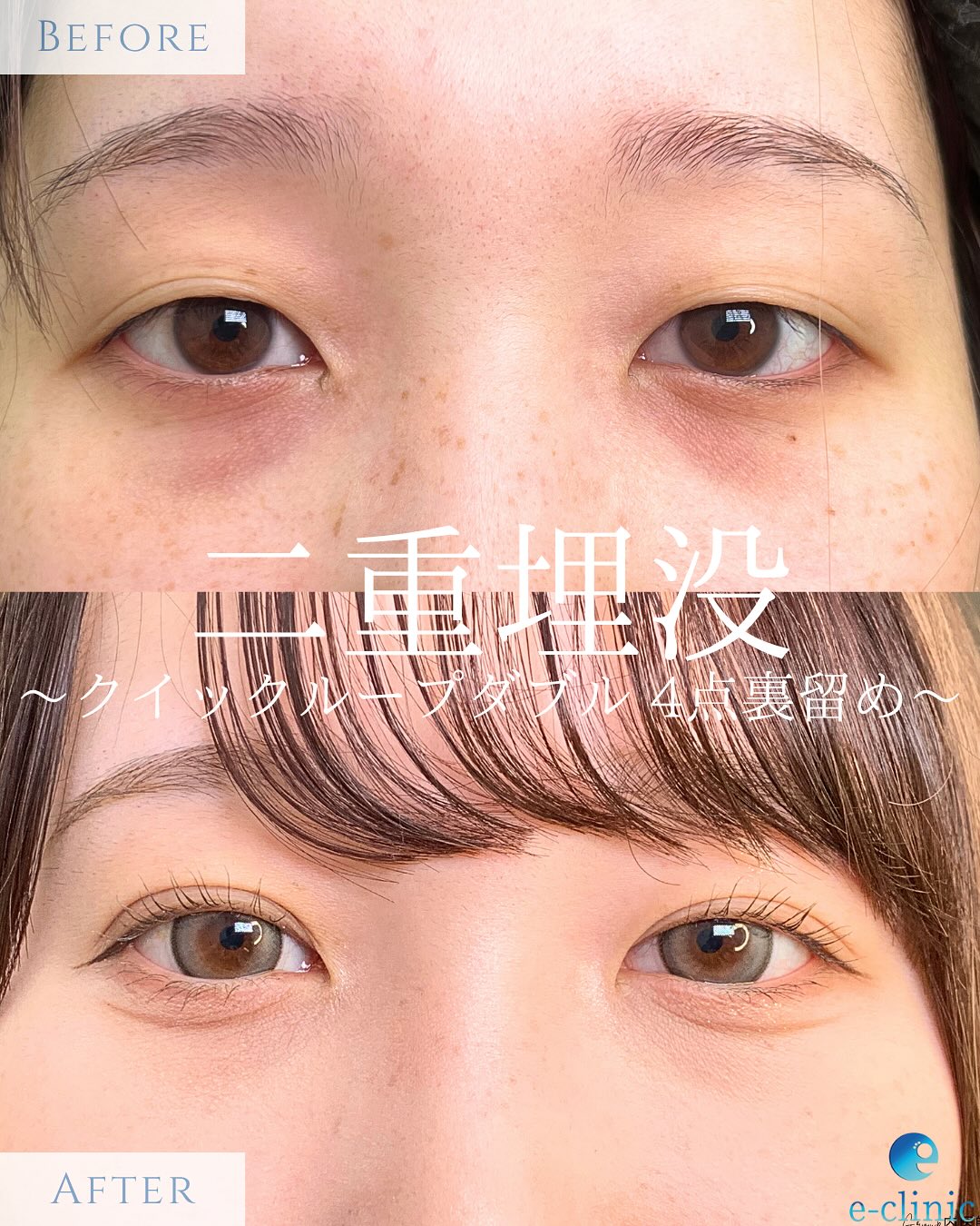 埋没法の症例写真 (2)