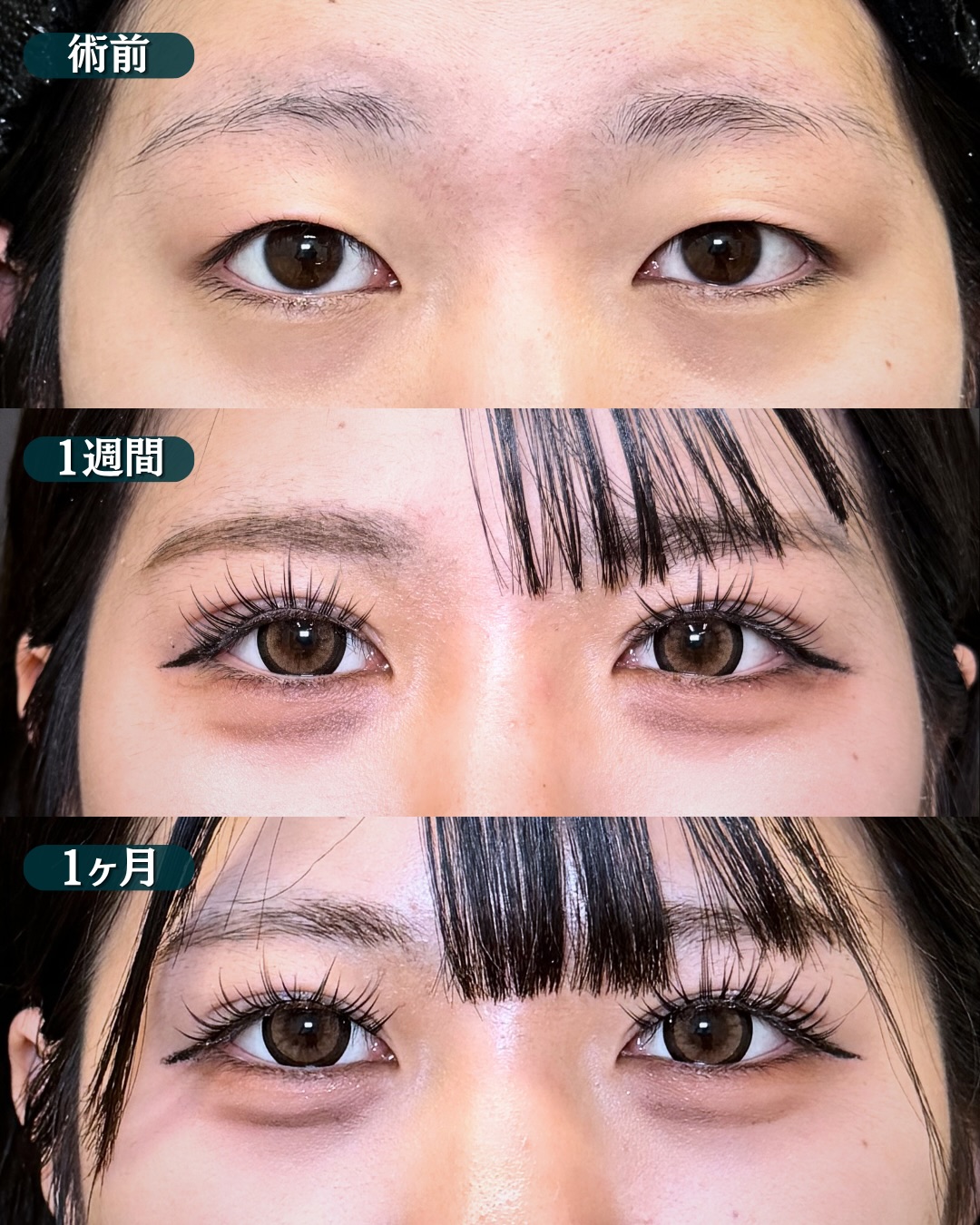 埋没法の症例写真 (8)
