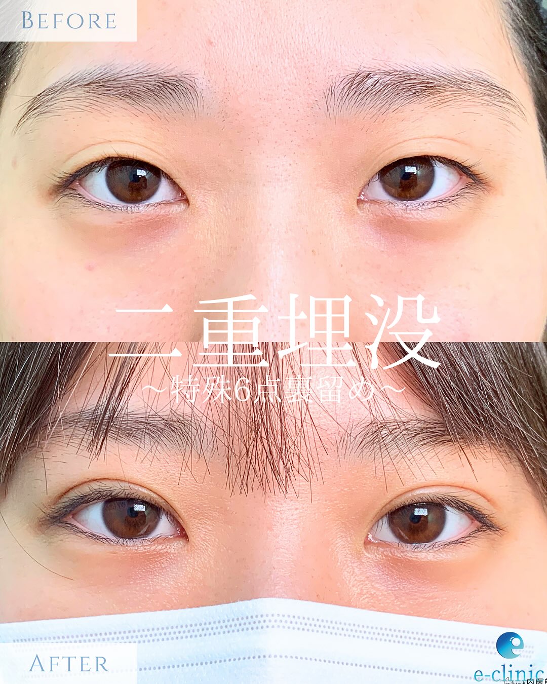 埋没法の症例写真 (5)
