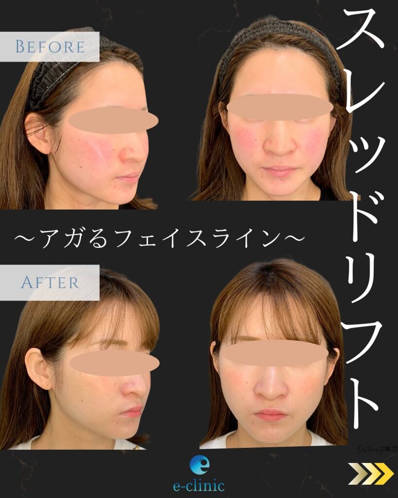 糸リフトの症例写真 (14)
