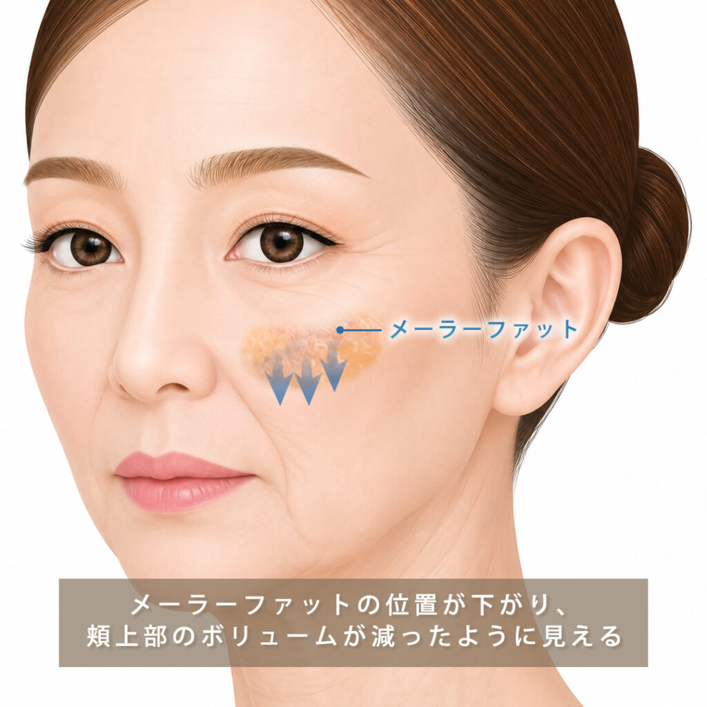 メーラーファットが下がり頬の位置が下がってしまっている図解