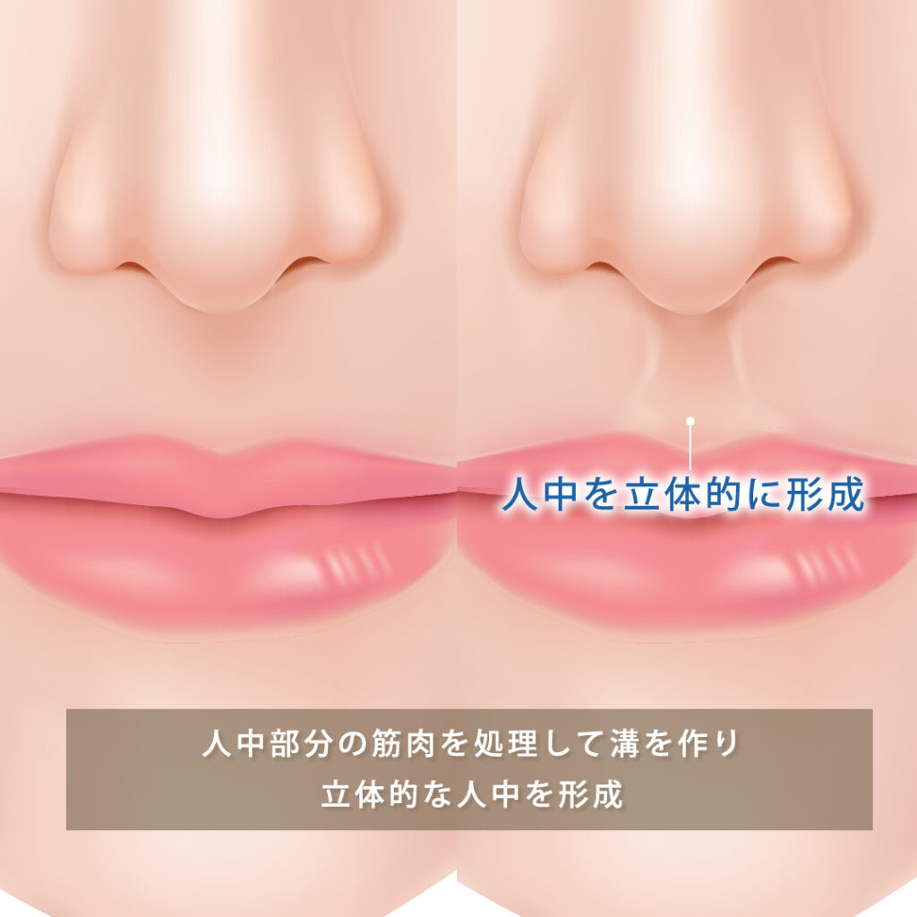 人中窩形成の図解