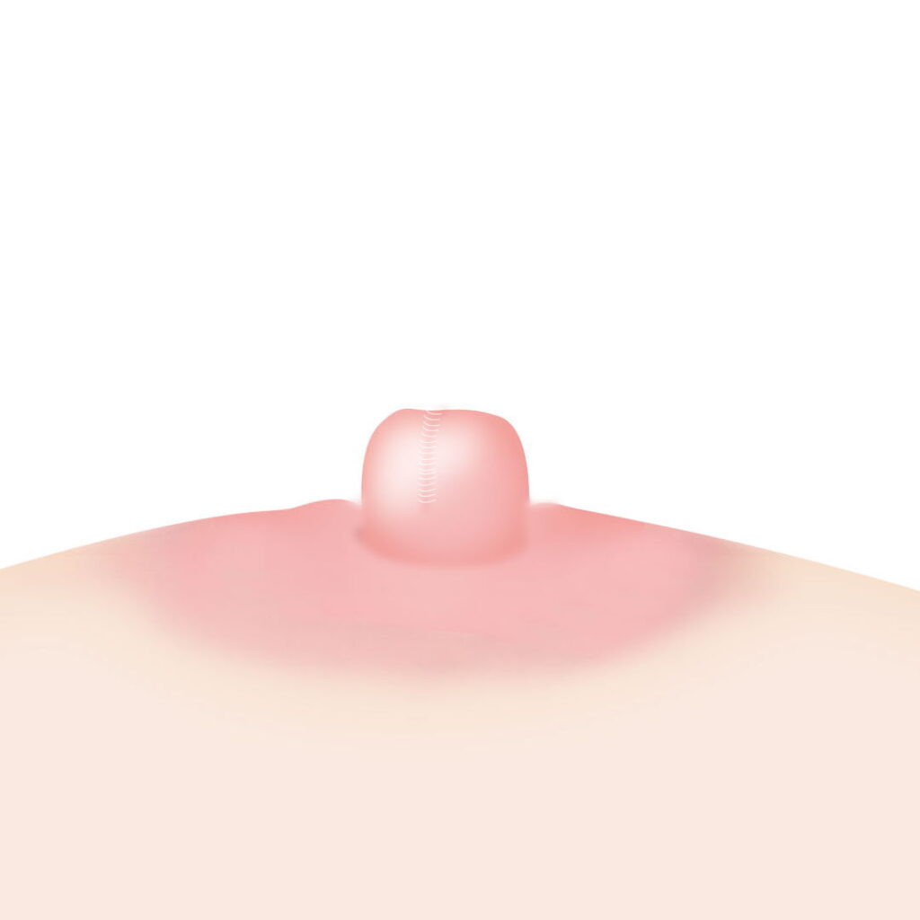 陥没乳頭手術で縫合をしている図解