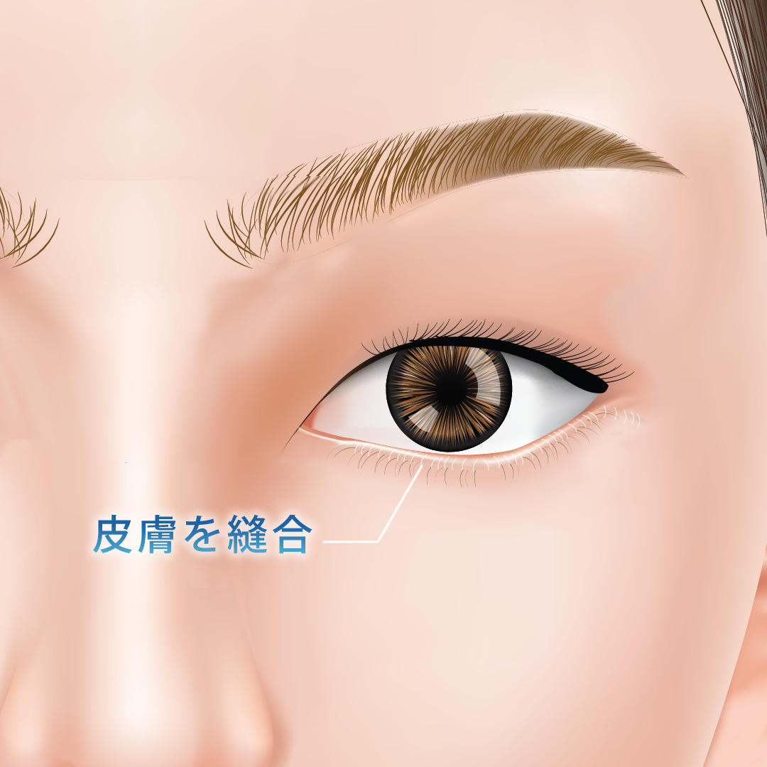下まつ毛の生え際の皮膚を縫合している図解