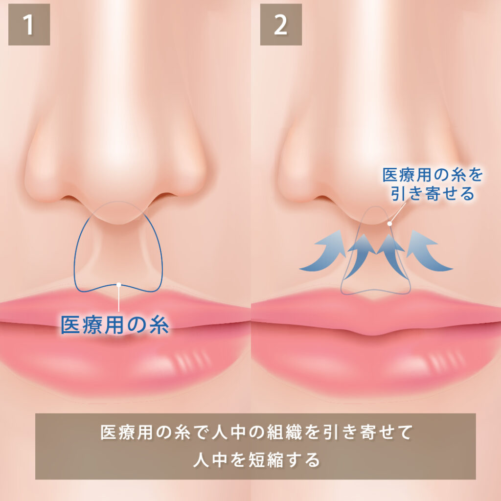 タッキング法による切らない人中短縮の図解