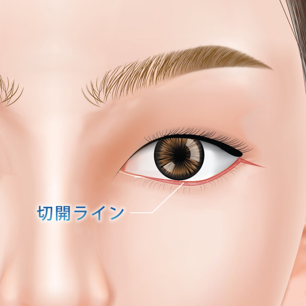 涙袋形成の切開ライン
