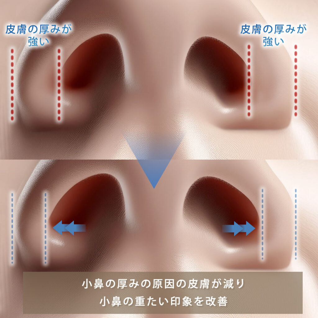 鼻腔拡大の図解
