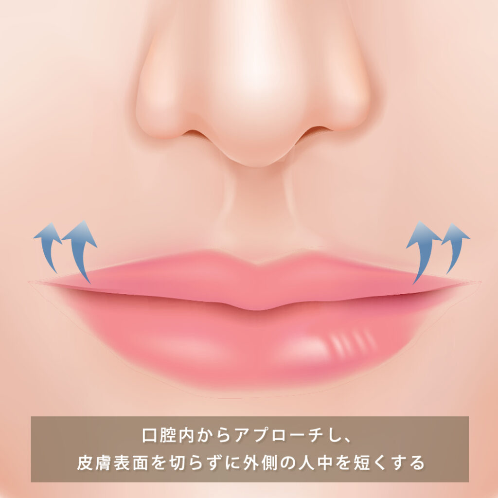 切らない外側人中短縮手術(粘膜切開法)の図解