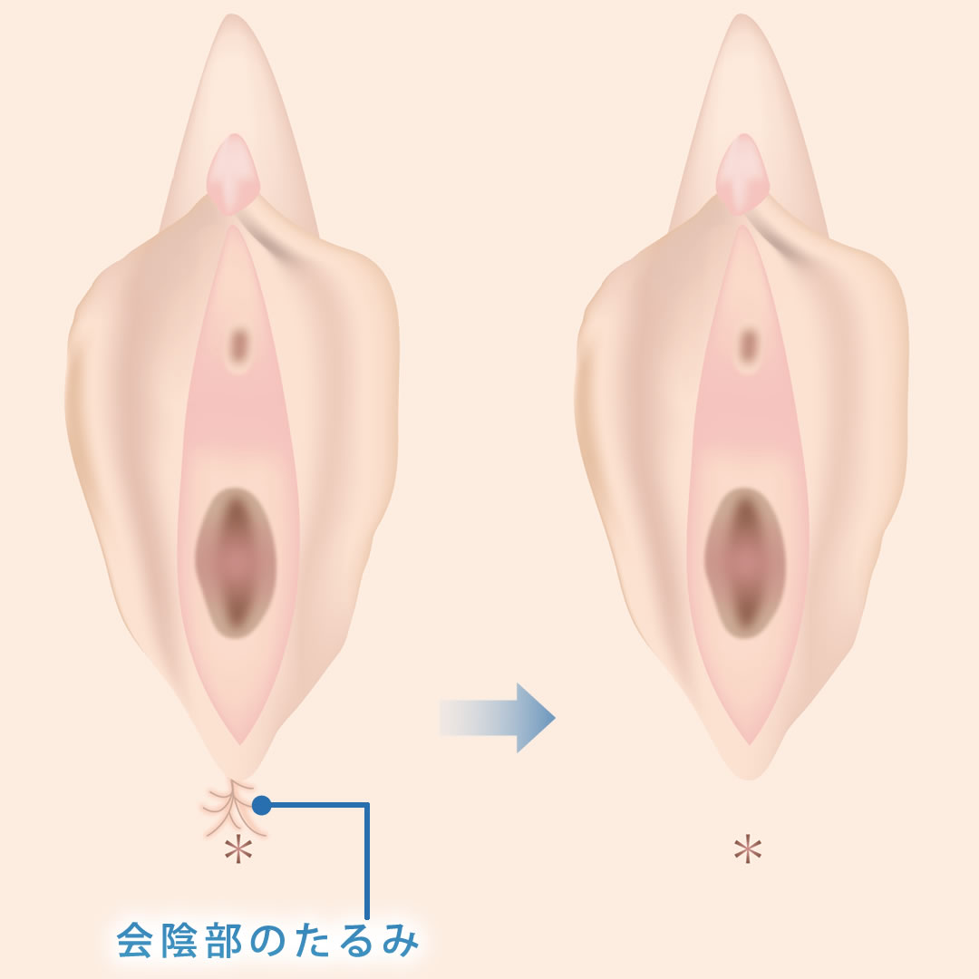 会陰部贅皮切除術のイメージ