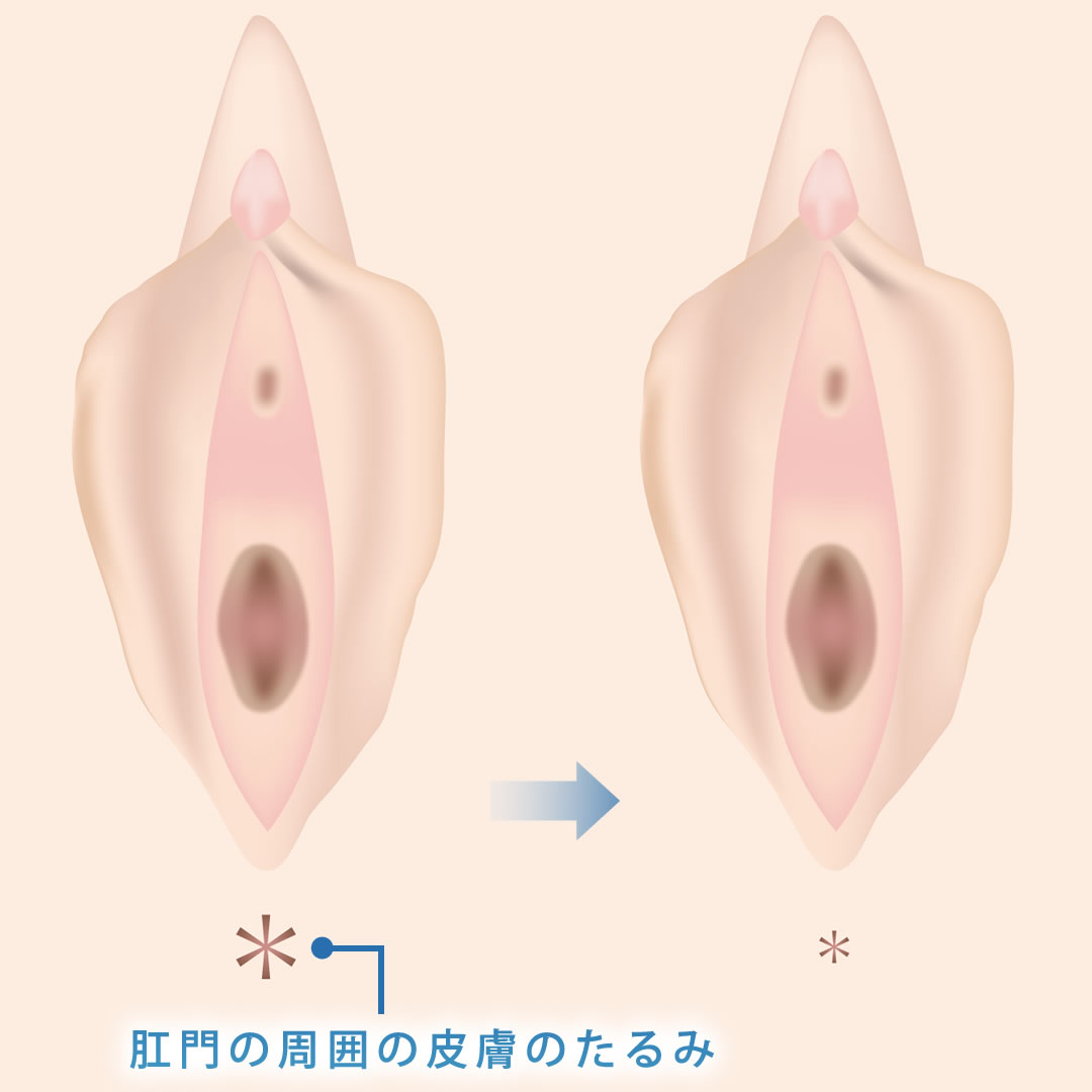 肛門周囲余剰皮膚切除のイメージ