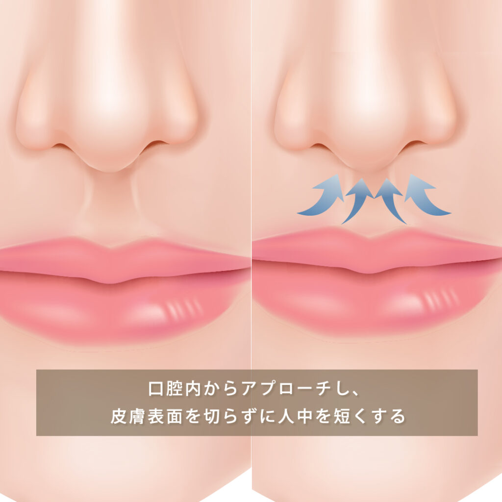 人中短縮手術(粘膜切開法)の図解
