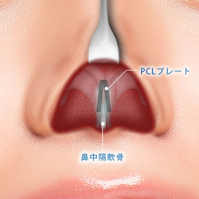 PCLプレートの図解
