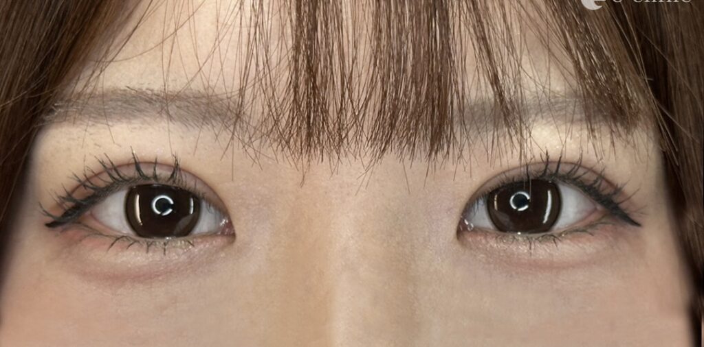 たるみ取り併用全切開二重術（284）術後