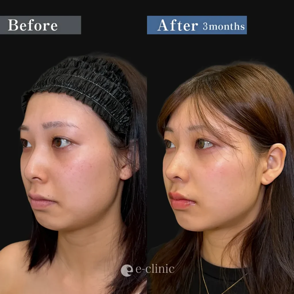 鼻整形_鼻尖形成3D法＋耳介軟骨移植＋鼻柱下降術＋小鼻縮小内側法＋引き締め縫合（相原隆充）（287）