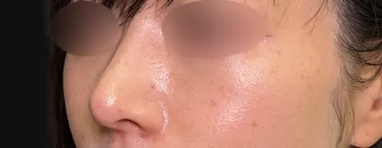 鼻整形_鼻尖形成3D法＋耳介軟骨移植＋鼻柱下降（相原隆充）（288）術後