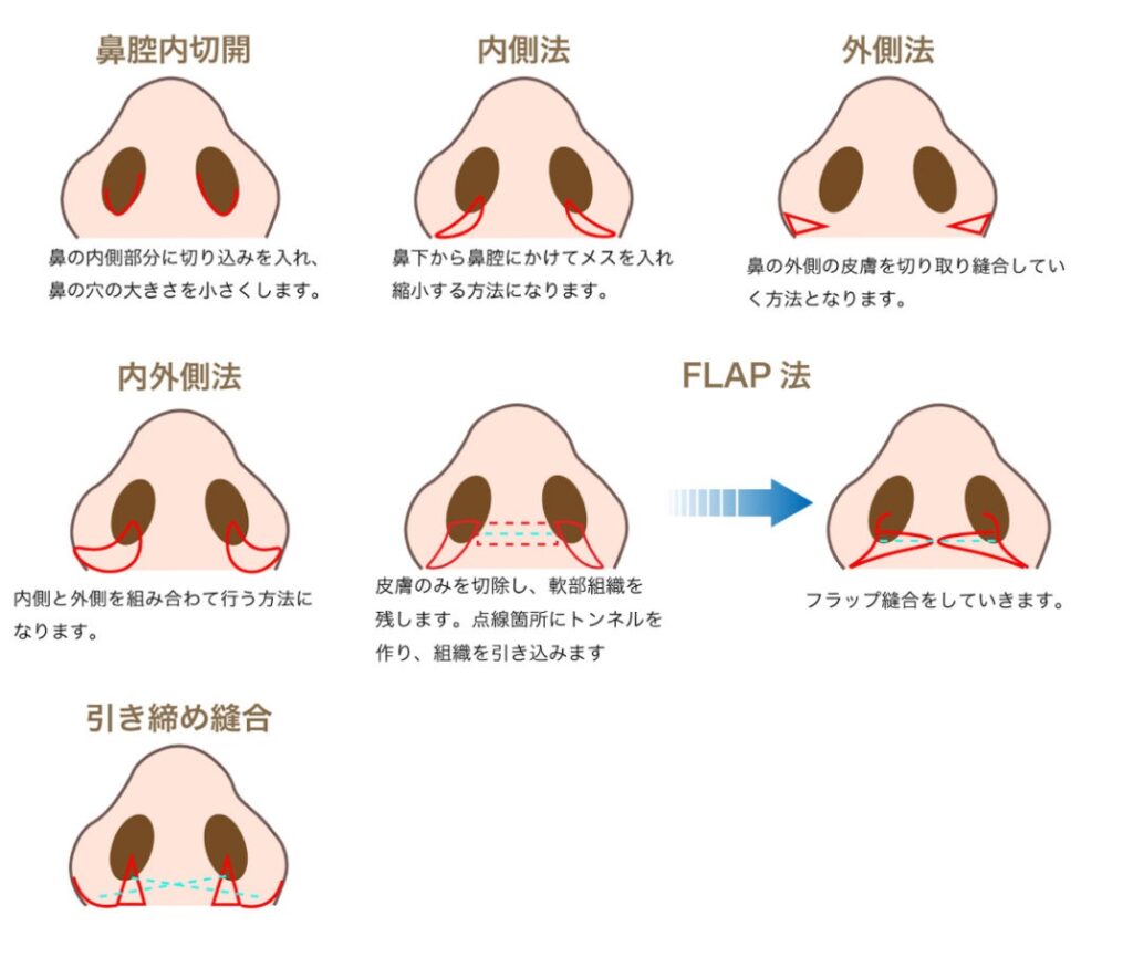 小鼻縮小手術の手術方法一覧