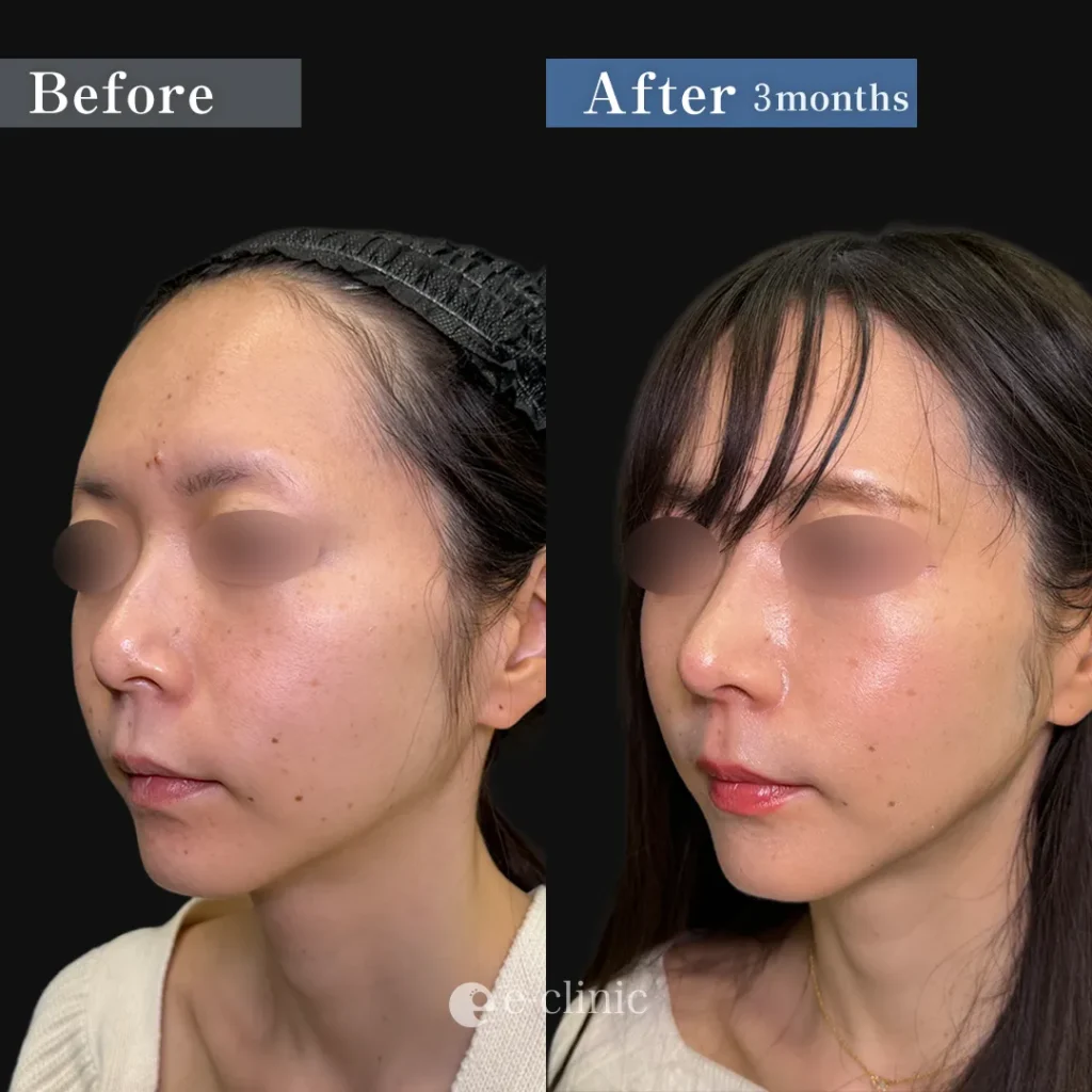 鼻整形_鼻尖形成3D法＋耳介軟骨移植＋鼻柱下降（相原隆充）（288）