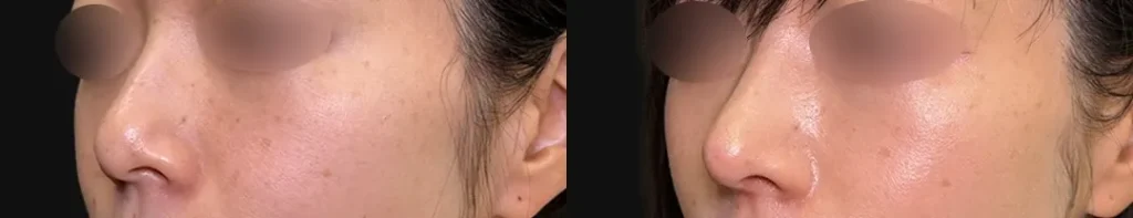鼻整形_鼻尖形成3D法＋耳介軟骨移植＋鼻柱下降（相原隆充）（288）比較